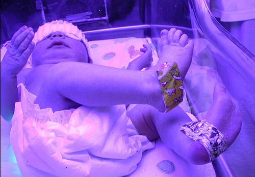 Hur att bekämpa gulsot i en nyfödd. Rådgör med din barnläkare om hur man kan behandla detta tillstånd.