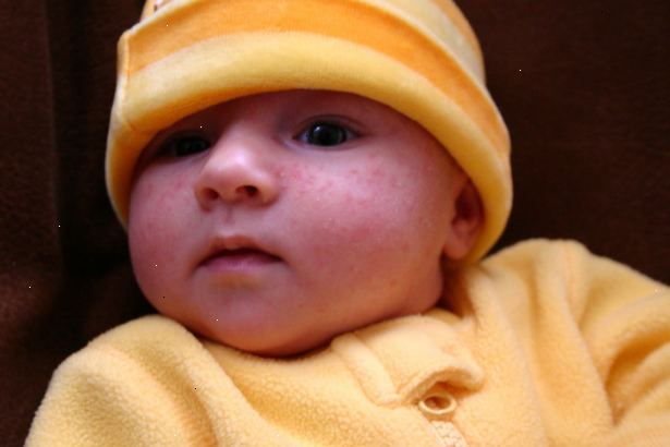 Hur man ska behandla baby akne. Behandla baby akne helt annorlunda tonåring eller vuxen akne.